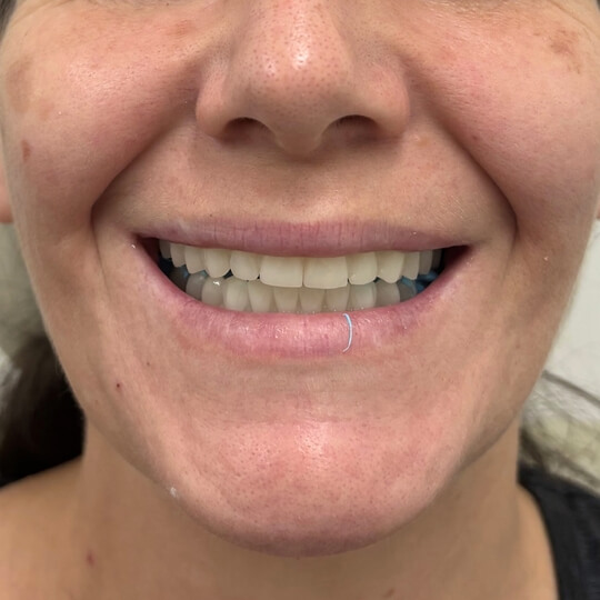 D3 Smile Transformation 10
