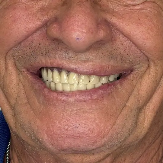 D3 Smile Transformation 4