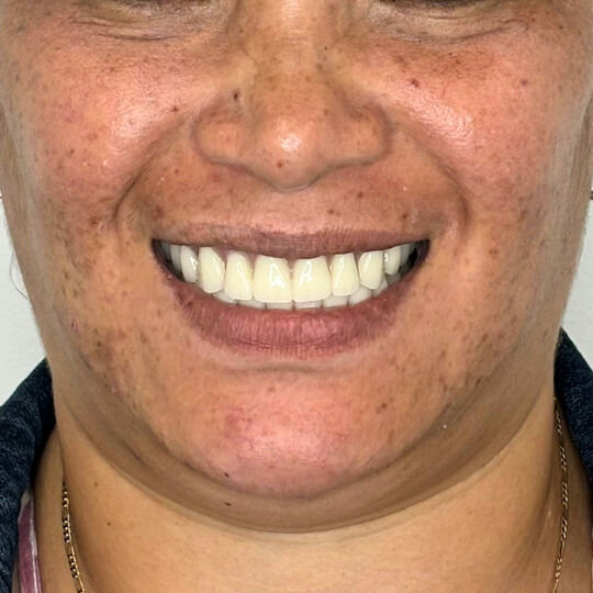 D3 Smile Transformation 5