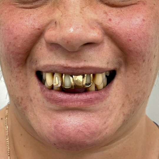 D3 Smile Transformation 6