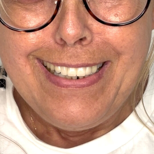 D3 Smile Transformation 7
