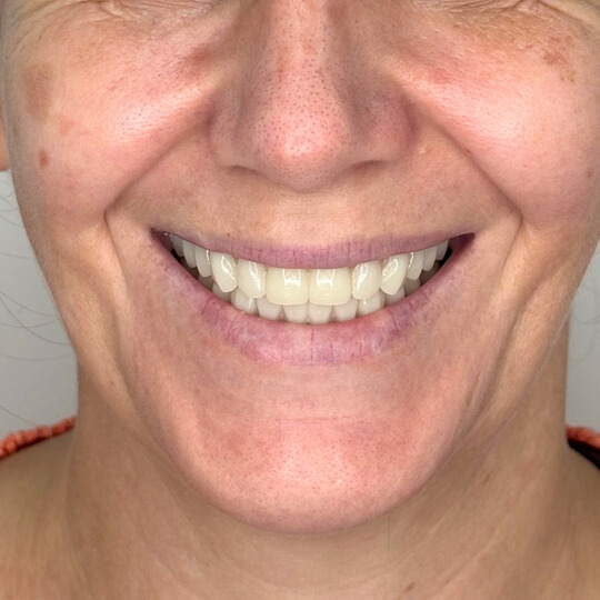 D3 Smile Transformation