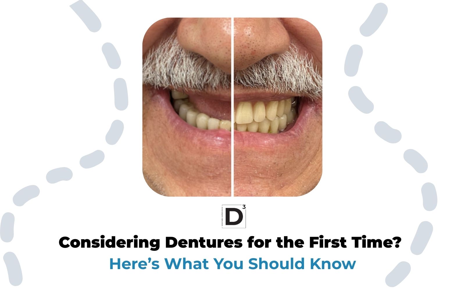 Considering Dentures for the First Time?